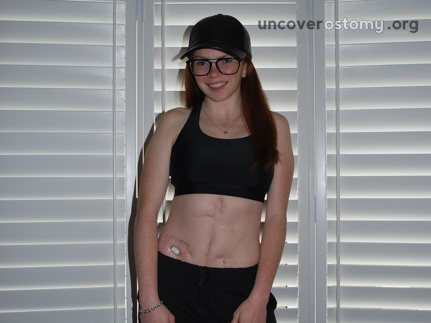 Acceptance Was Easy Confidence Was Not Uncover Ostomy